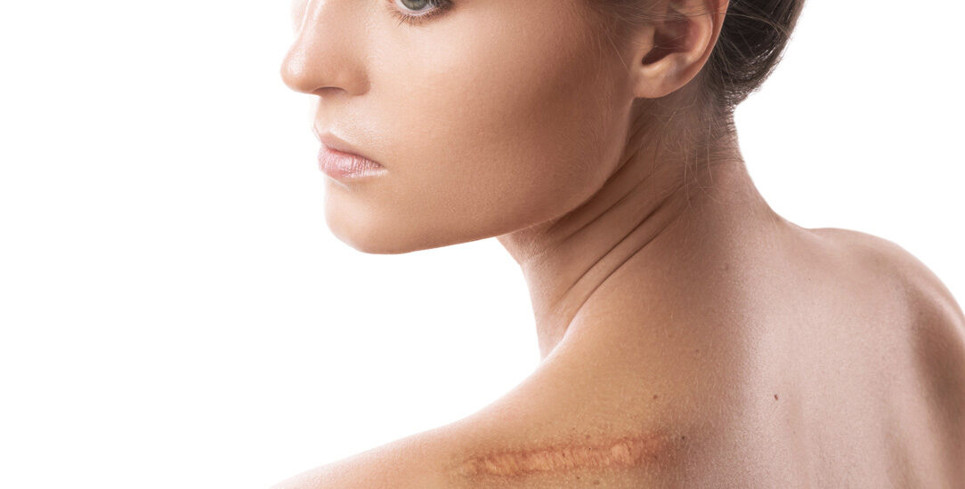 Zdjęcie przedstawiające profesjonalny zabieg redukcji blizn pooperacyjnych, mający na celu poprawę wyglądu skóry po operacjach.