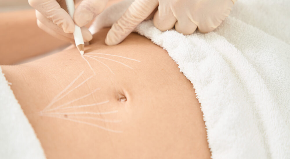 Innowacje w liposukcji – przegląd nowoczesnych technik modelowania sylwetki dla najlepszych efektów. Chirurgia plastyczna Wrocław.