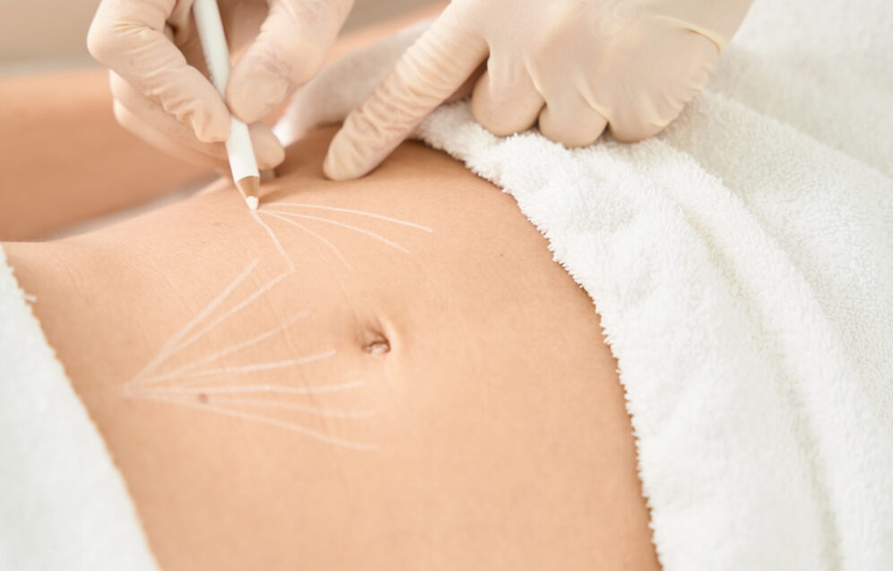 Innowacje w liposukcji – przegląd nowoczesnych technik modelowania sylwetki dla najlepszych efektów. Chirurgia plastyczna Wrocław.