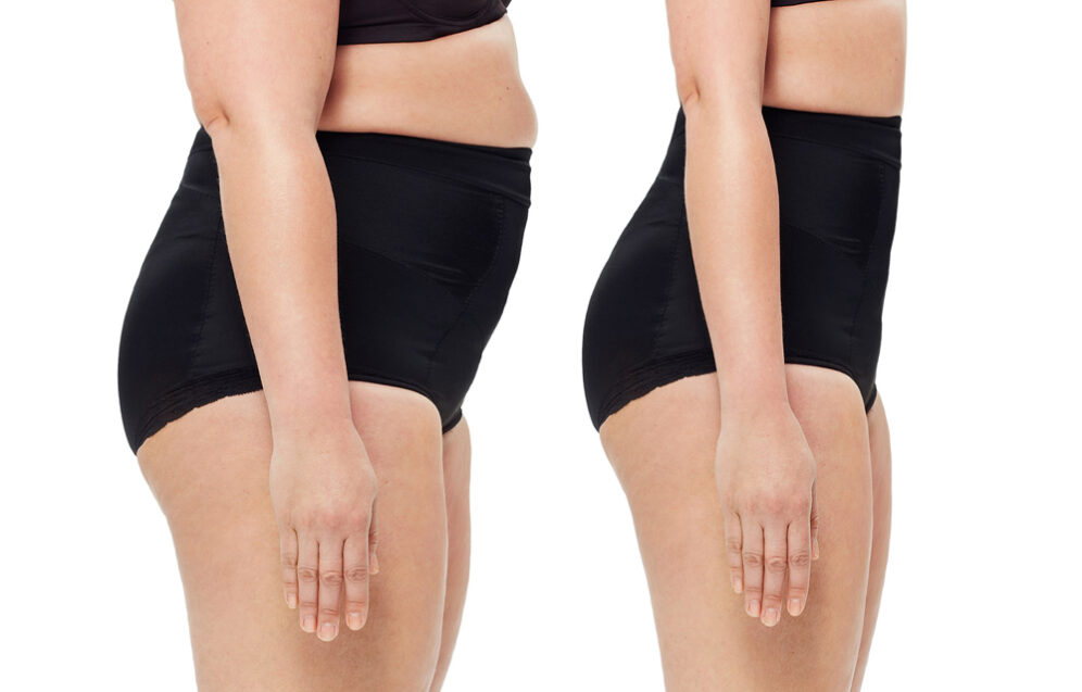 Plastyka brzucha (abdominoplastyka) – wskazania, przebieg operacji i efekty zabiegu poprawiającego sylwetkę. Chirurgia plastyczna Wrocław.