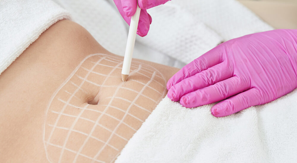 Precyzyjne zastosowanie lasera w chirurgii plastycznej – Chirurgia plastyczna Wrocław