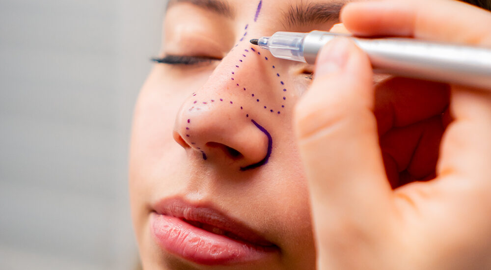 Plastyka nosa poprawiająca estetykę twarzy oraz funkcjonalność dróg oddechowych.