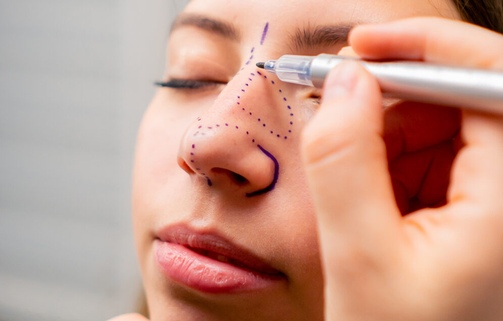 Plastyka nosa poprawiająca estetykę twarzy oraz funkcjonalność dróg oddechowych.