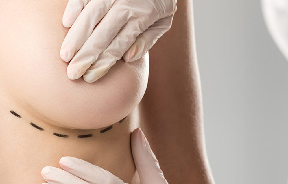 Lipofilling – przeszczep tłuszczu jako alternatywa dla implantów, analiza badań, skuteczność i trwałość wyników. Chirurgia plastyczna Wrocław.