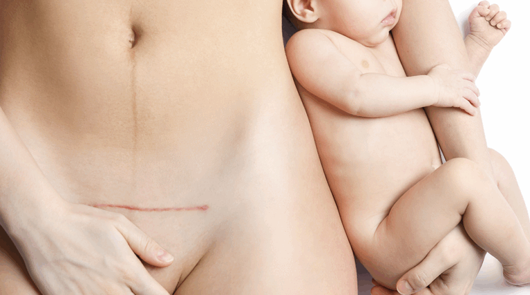 mommy makeover mommy makeover