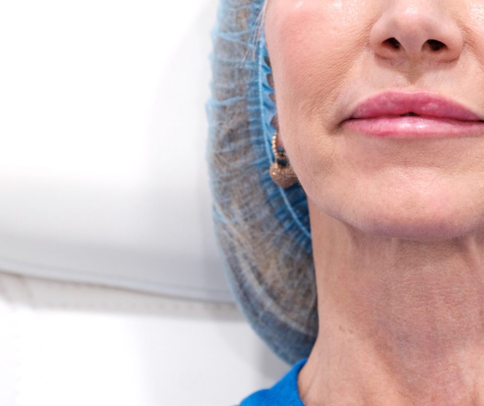 Close up picture of lips taking hyaluronic acid injections in an aesthetic clinic. Non-surgical treatment to reduce wrinkles and avoid aging. Copy space for titles