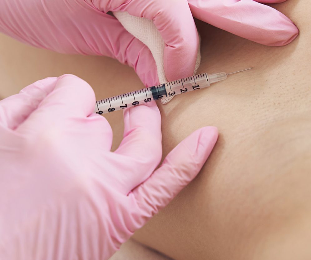 medycyna-estetyczna-wroclaw-leczenie-nadpotliwosci-3